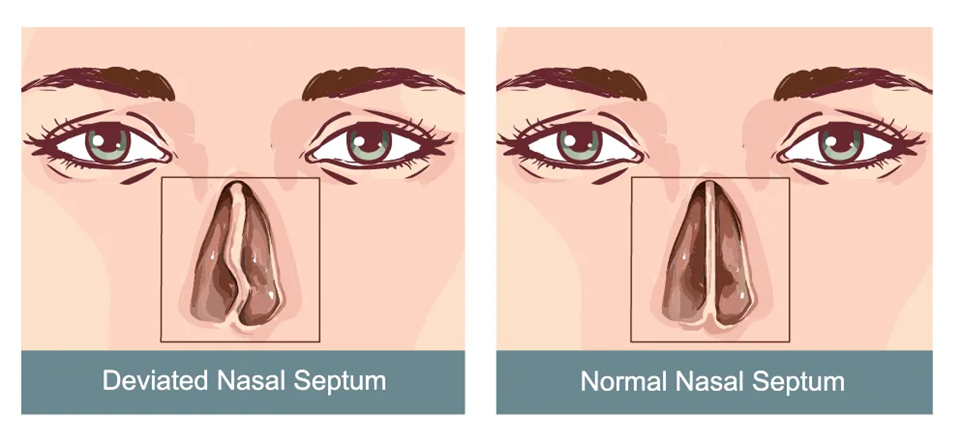 鼻塞复发?仁树眼耳鼻侯专家指出或与鼻腔「假平衡」有关